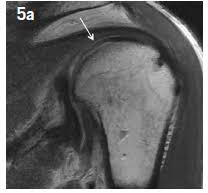 An mri scan price in the philippines can range from php 3,500 to php 8,000 or more depending on which body part requires the test. Aspetar Sports Medicine Journal Imaging The Painful Shoulder In Swimmers