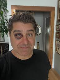 My eye is healing up…and I thought the set of @mythbusters was dangerously.