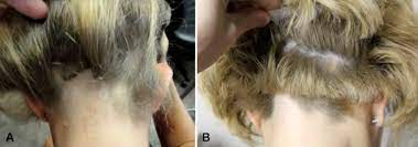 Affected women may experience psychological distress and impaired social functioning. Successful Treatment Of Corticosteroid Resistant Ophiasis Type Alopecia Areata Aa With Platelet Rich Plasma Prp Jaad Case Reports