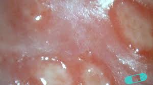 Sweat is one of the leading causes of pimples on your vulva, so make sure you change out of any moist or sweaty clothing and keep the. Genital Sores Online Dermatology