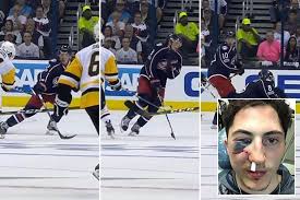 Jul 11, 2020 · the athletic protected vladislav gavrikov in addition to the obvious selections of zach werenski and seth jones; Ice Hockey Star Reveals Horrific Bloodied Face And Almost Loses Eye After Being Hit With Puck
