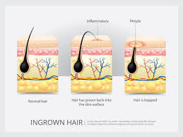 Browse ingrown hair pictures, photos, images, gifs, and videos on photobucket 449 Ingrown Hair Stock Photos And Images 123rf