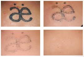 One way to ensure a quick laser tattoo removal for new tattoos is to find a powerful device like picosure laser. Permanent Tattoo Removal Services Laser Treatment Center à¤² à¤œà¤° à¤Ÿ à¤° à¤Ÿà¤® à¤Ÿ à¤² à¤œ à¤° à¤Ÿ à¤° à¤Ÿà¤® à¤Ÿ In Gki Basement Delhi Flasers Id 9419375297