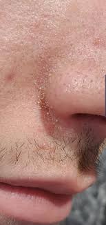 Keratin plug close up #1 don´t click here keratin plug removal don´t click here: Skin Concerns Keratin Plugs Seb Fill How Do I Get Rid Of Them Skincareaddiction