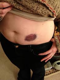 Available in 30 mg, 40 mg/0.4 ml, 60 mg, 100 mg, 120 mg, and 150 mg. Searching For Our Silver Lining For The Love Of Lovenox