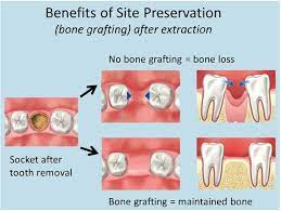 From a bone graft and membrane, your gums might feel sore, as if you bit wrong on a chip and it made your gums hurt. Bone Grafting Sunlight Dental Group Pearland Tx