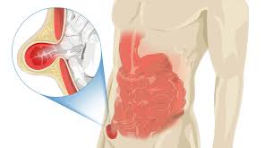 Image result for Inguinal hernia man