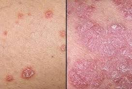 Tinggal di negara tropis seperti. Obat Penyakit Gatal Kulit Kering Bersisik Dan Mengelupas Obat Psoriasis