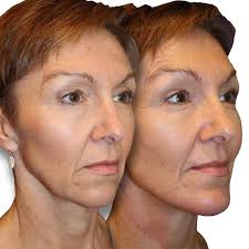 Taking you to the OR with #DiamondDishes! It's always rewarding to see the  lift of the face, neck, jowls come together in real time in the operating  room. Q: Hey Dr. Diamond,