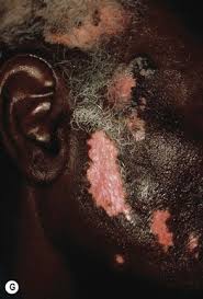 Image result for Postinflammatory Hypopigmentation
