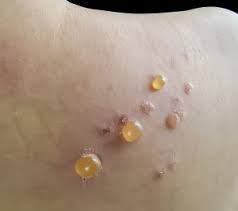 Image result for Pemphigoid