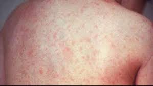 La 1 an si 2 luni ii fac baiatului vestitul vaccin ror. Tot Ce Trebuie SÄƒ StiÅ£i Despre Vaccinul Ror Impotriva Rujeolei Oreionului Rubeolei