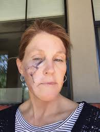 Five Years Cancer-Free!