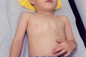 Pectus excavatum, also known as funnel chest, is a condition where the breastbone of the sufferer grows inward. Pectus Carinatum Springerlink