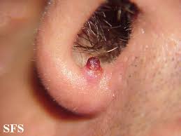 Maybe you would like to learn more about one of these? Pyogenic Granuloma Wikidoc