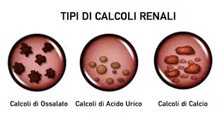 La dieta per prevenire i calcoli renali. Calcoli Renali La Prevenzione E I Rimedi