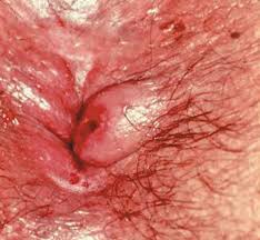 Thrombosed hemorrhoids (picture 7) is considered a separate form of the disease. Anorectal Complaints Office Diagnosis And Treatment Part 1 Consultant360