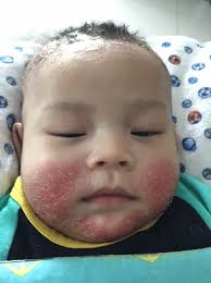 Pakar kulit ezcema malaysia, kuala lumpur, malaysia. 5 Months Of Agony Severe Eczema Cerita Eczema Aryan