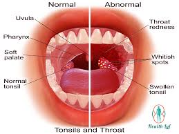 Strep throat vs sore throat vs colds vs flu. Healthy Healthy Throat Vs Sore Throat Pictures