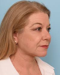 Fat Transfer Before & After Photos