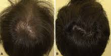 It works by stopping hair loss and in some cases, it can even help regrow new hair. Oral Minoxidil To Treat Hair Loss Hair Loss Cure 2020