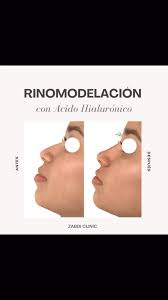 ¿En qué consiste una RINOMODELACIÓN con ácido hialurónico?, Es un  tratamiento estético que se realiza con técnicas no invasivas, consiste en  la inyección de rellenos dérmicos en la nariz para corregir ...
