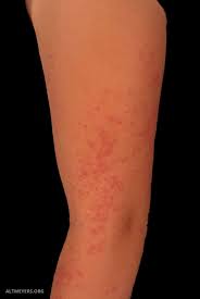 A skin rash may be a new, rare symptom of coronavirus, according to doctors. Virus Exanthema Overview Altmeyers Encyclopedia Department Dermatology