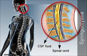 Image result for Syringomyelia