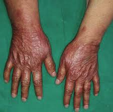 Image result for Photodermatitis