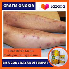 Obat salep luka knalpot qnc jelly gamat merupakan produk obat sekaligus salep terpopuler saat ini. Obat Darah Manis Prurigo Amis Daging Budug Di Kaki Penyakit Kulit Obat Untuk Menghilangkan Bekas Budug Obat Budugan Terbaik Herbal Qnc Jelly Gamat Asli 100 Alami