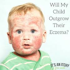 Will My Child Outgrow Their Eczema A Clinical Perspective Of The Development Of Atopic Dermatitis Baby Eczema Childhood Asthma Atopic Dermatitis