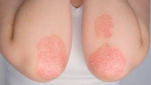 Tratandosi i una malattia autoimmune, il rischio estremo è quello della morte. Malattie Della Pelle Quali Sono Le Piu Comuni E Le Cause Ohga