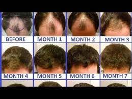 This is a normal part of the hair growth cycle. Hair Transplant How Much Time For Hair Growth After Transplant Youtube