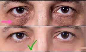 7 Tips Y Trucos Para Quitar Las Ojeras En Hombres Metodos Para Ligar