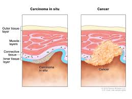 The direct translation seems to be a small, dark person but i hear it in spanish songs a lot and i'm not sure if there's a cultural aspect of the word. Definition Of Carcinoma In Situ Nci Dictionary Of Cancer Terms National Cancer Institute