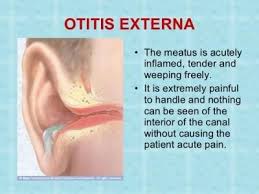 Image result for Acute Otitis Externa