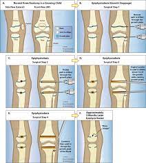 Growth Plate Fusion (Epiphysiodesis) | International Center For Limb  Lengthening