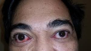 Image result for Proptosis