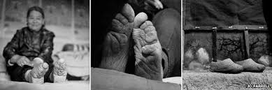 Forefoot/ball of foot pain (metatarsalgia): Chinese Foot Binding Bbc News