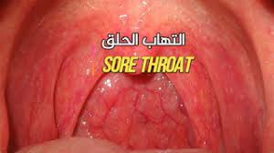 التهاب الحلق احتقان الحلق الأسباب والعلاج طبيب نت blog posts blog post