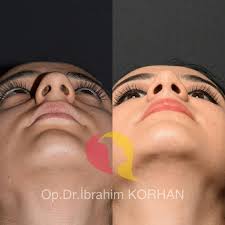 Kapali Rinoplasti 3 Ay Sonrasi Diger Acilari Ve Oncesi Cok Merak Edildigi Icin Paylastim Rhinoplasty Foll Nose Surgery Rhinoplasty Rhinoplasty Perfect Nose