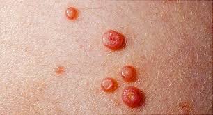 Nobody even likes ingrown hairs in the first place, let alone having it in a very sensitive and private body area like the pubic region. Rashes Bumps And Lumps Below The Belt