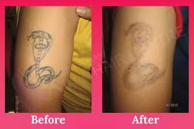 Recent research suggests tattoos are as popular as ever, with a however, ms maeva also notes there are several other reasons you might decide to get your tattoo removed. Tattoo Removal Cost India Tattoo Design