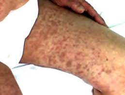 Plachetele (trombocitele) sangvine sunt celule incol. Porpora Trombocitopenica Idiopatica