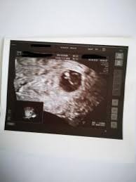 „das herz beginnt bereits am 22. Bei 7 4 Noch Kein Herzschlag Und Baby Zu Klein Forum Schwangerschaft Urbia De