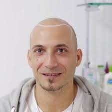 Scalp Micropigmentation Sydney Fashionable & Stylish Hair Tattoo