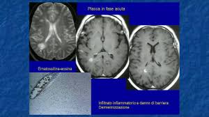 La risonanza magnetica è infatti in grado di evidenziare con precisione le placche tipiche della sclerosi multipla. 07 Imaging Della Sclerosi Multipla Alessandra Erbetta Youtube