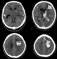 Ct Fluid Blood Levels In Covid 19 Intracranial Hemorrhage American Journal Of Neuroradiology