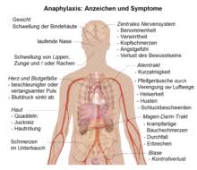 Anaphylaxie, systemische anaphylaktische reaktion, systemische anaphylaxie, anaphylaktische reaktion, anaphylaktischer schock, nicht naeher bezeichnet. Anaphylaxie Wikipedia