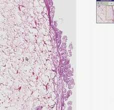 Histopathology Lung Pleura Mesothelioma Youtube